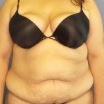 High BMI (Larger Patients) Surgery Before & After Patient #10340