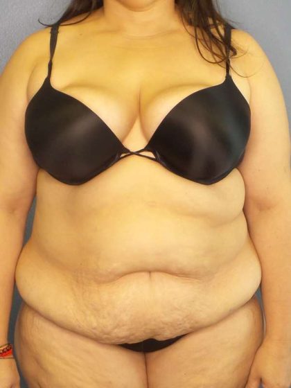 High BMI (Larger Patients) Surgery Before & After Patient #10340