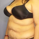 High BMI (Larger Patients) Surgery Before & After Patient #10340