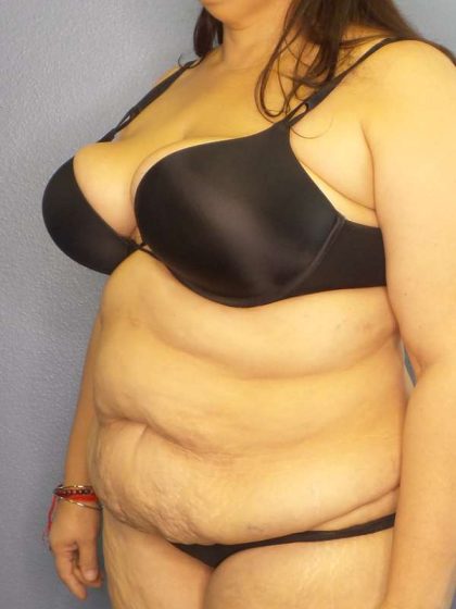 High BMI (Larger Patients) Surgery Before & After Patient #10340