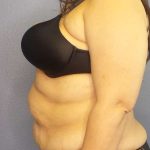 High BMI (Larger Patients) Surgery Before & After Patient #10340