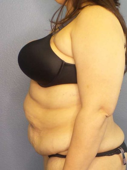 High BMI (Larger Patients) Surgery Before & After Patient #10340