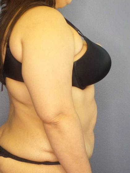 High BMI (Larger Patients) Surgery Before & After Patient #10340
