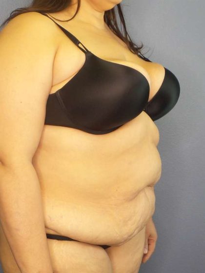 High BMI (Larger Patients) Surgery Before & After Patient #10340