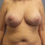 High BMI (Larger Patients) Surgery Before & After Patient #4569