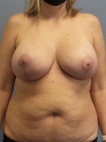 High BMI (Larger Patients) Surgery Before & After Patient #4569