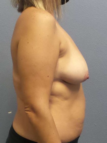 High BMI (Larger Patients) Surgery Before & After Patient #4569