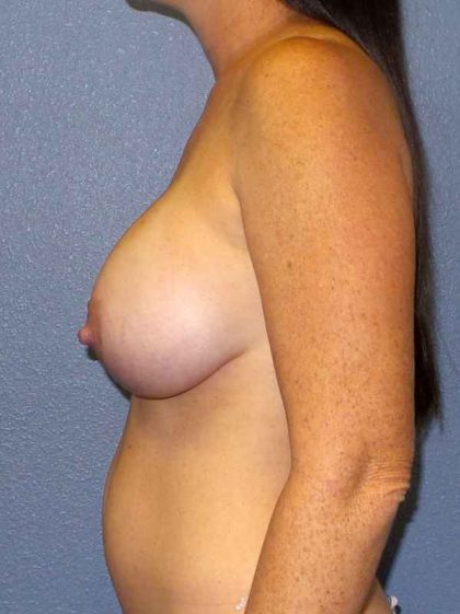 Breast Augmentation Before & After Patient #5059