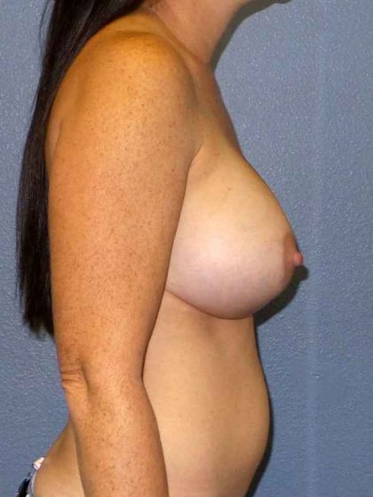 Breast Augmentation Before & After Patient #5059