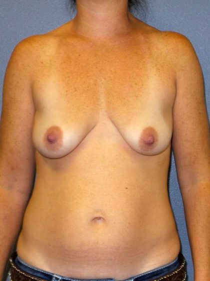 Breast Augmentation Before & After Patient #5059