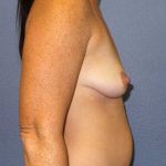 Breast Augmentation Before & After Patient #5059