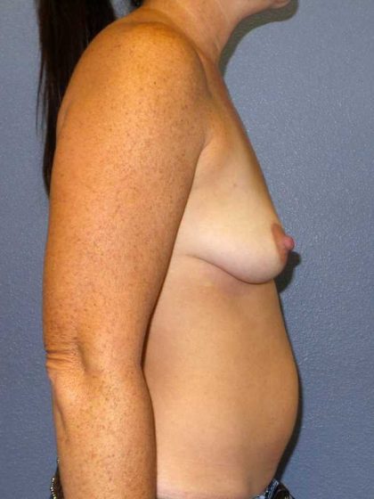 Breast Augmentation Before & After Patient #5059