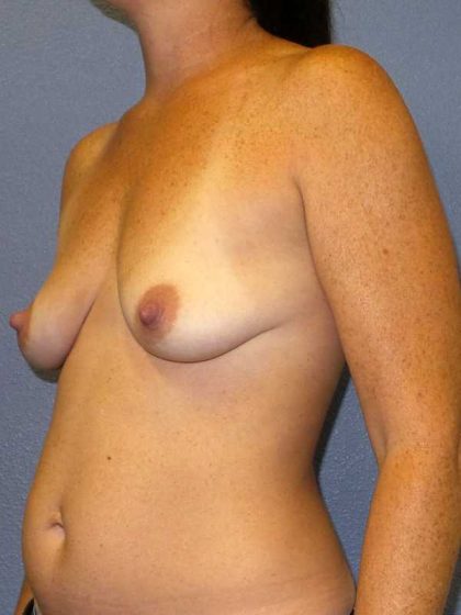 Breast Augmentation Before & After Patient #5059