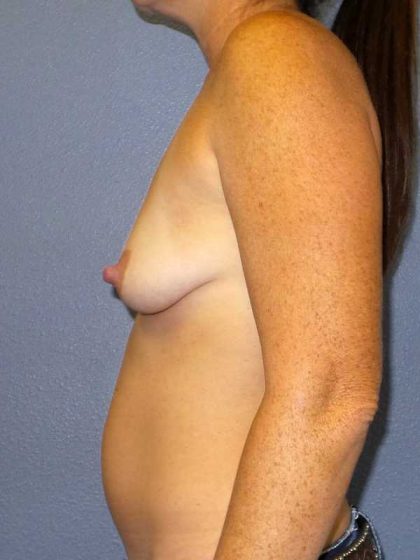 Breast Augmentation Before & After Patient #5059