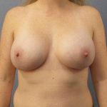 Breast Augmentation Before & After Patient #5083