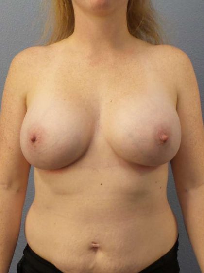 Breast Augmentation Before & After Patient #5083