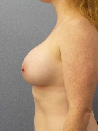 Breast Augmentation Before & After Patient #5083