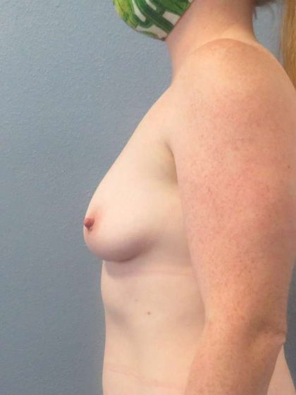 Breast Augmentation Before & After Patient #5083