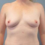 Breast Augmentation Before & After Patient #5083