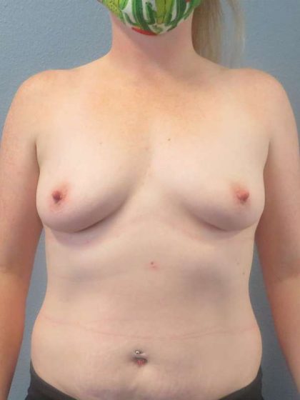 Breast Augmentation Before & After Patient #5083