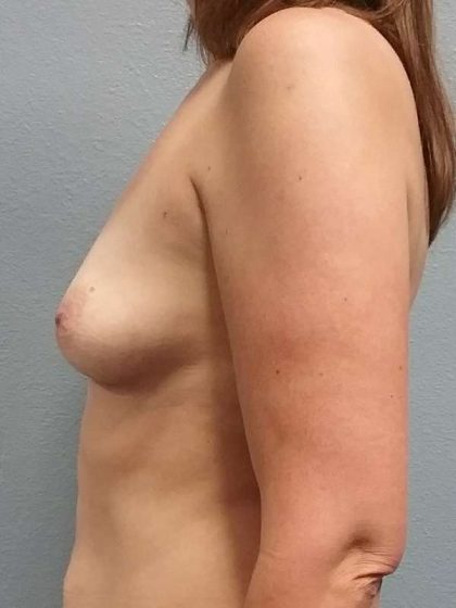 Breast Augmentation Before & After Patient #5645