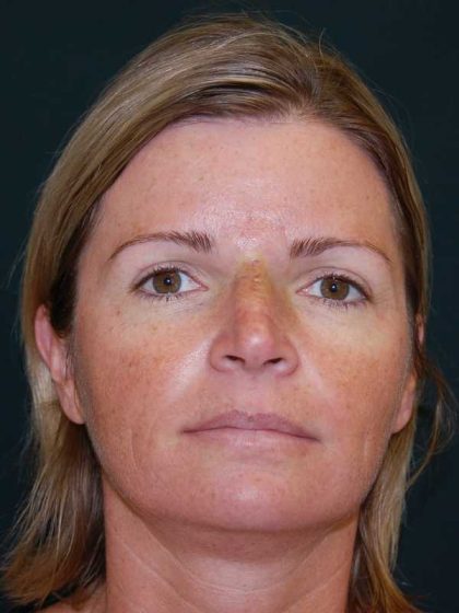 Filler Before & After Patient #7593