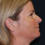 Filler Before & After Patient #7593