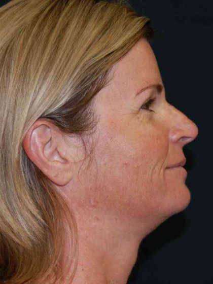 Filler Before & After Patient #7593