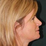 Filler Before & After Patient #7593