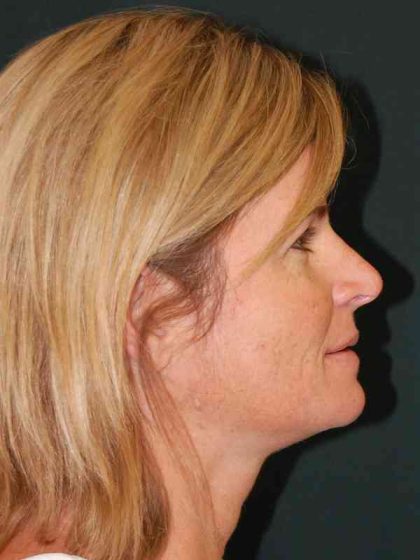 Filler Before & After Patient #7593
