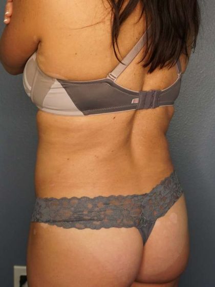 Brazilian Butt Lift Before & After Patient #4914