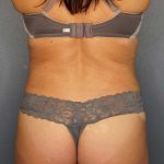 Brazilian Butt Lift Before & After Patient #4914