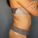 Brazilian Butt Lift Before & After Patient #4914