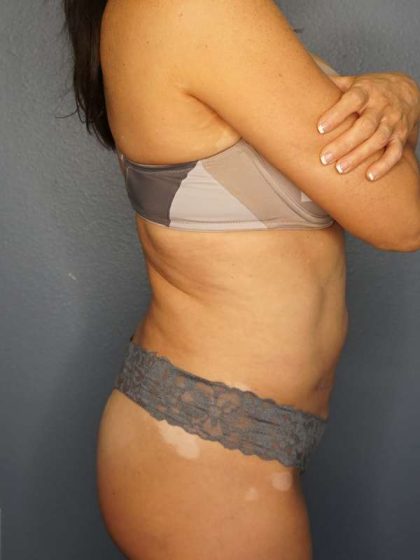 Brazilian Butt Lift Before & After Patient #4914