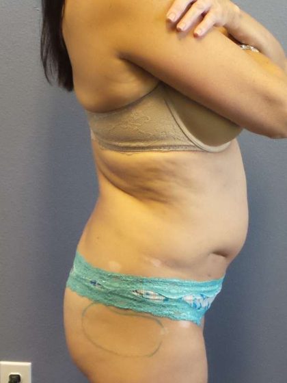 Brazilian Butt Lift Before & After Patient #4914