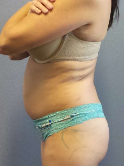 Brazilian Butt Lift Before & After Patient #4914