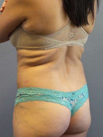 Brazilian Butt Lift Before & After Patient #4914