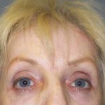 Periorbital Before & After Patient #8580