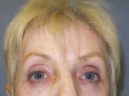 Periorbital Before & After Patient #8580