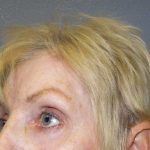 Periorbital Before & After Patient #8580