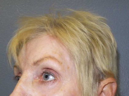 Periorbital Before & After Patient #8580