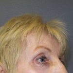 Periorbital Before & After Patient #8580
