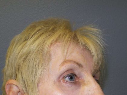 Periorbital Before & After Patient #8580