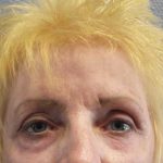 Periorbital Before & After Patient #8580