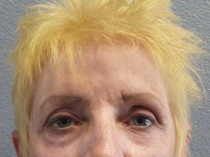 Periorbital Before & After Patient #8580