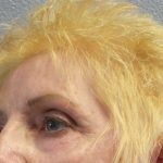 Periorbital Before & After Patient #8580