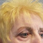 Periorbital Before & After Patient #8580