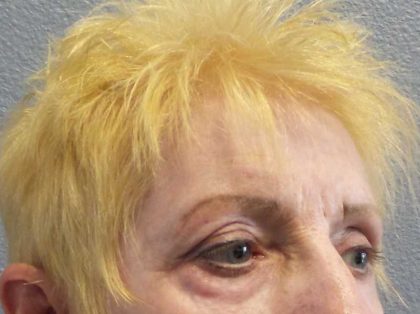 Periorbital Before & After Patient #8580