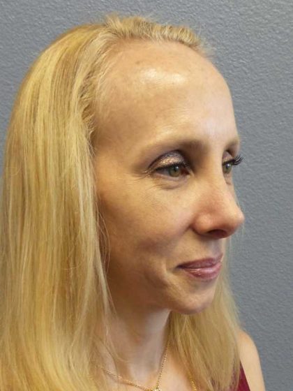 Rhinoplasty Before & After Patient #10061