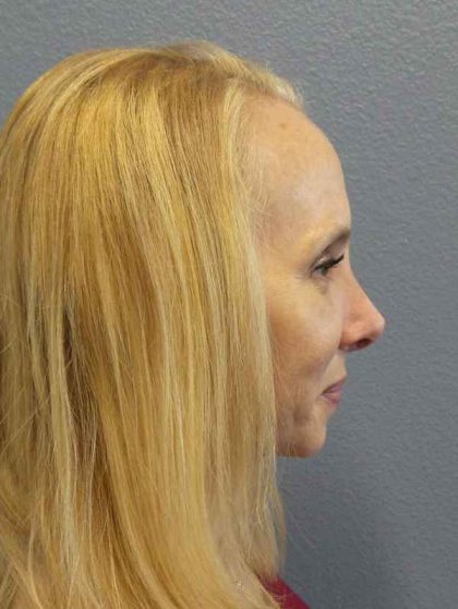 Rhinoplasty Before & After Patient #10061